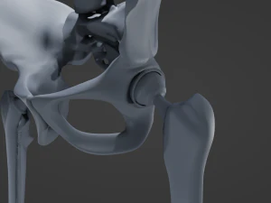 Substitui&ccedil;&atilde;o de quadril Modelo 3D