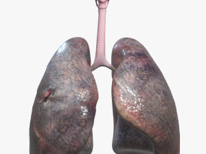 Smokers Lungs 3D Model