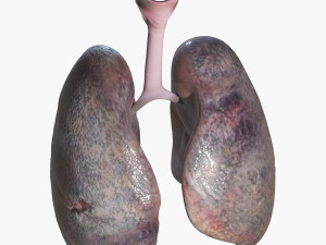 Smokers Lungs Modelo 3D