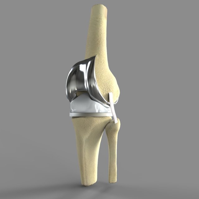 Knee Replacement Modelo 3D .c4d .max .obj .3ds .fbx .stl .blend 