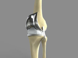 Substitui&ccedil;&atilde;o do joelho Modelo 3D