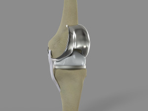 Knee Replacement Modelo 3D