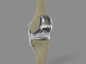 Knee Replacement 3D Model