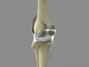 Knee Replacement Modelo 3D