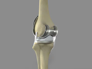 Knee Replacement 3D Model