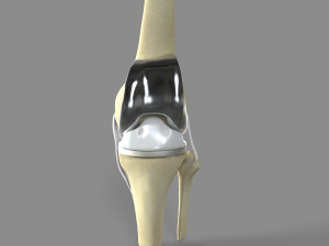 Knee Replacement Modelo 3D