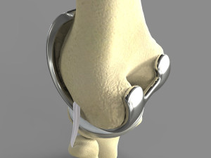 Knee Replacement Modelo 3D