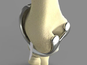 Knee Replacement 3D Model