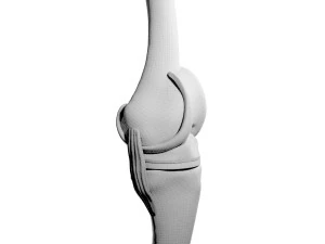 Knee Replacement 3D Model