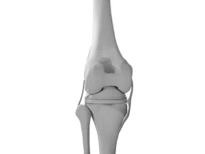 Knee Replacement 3D Model