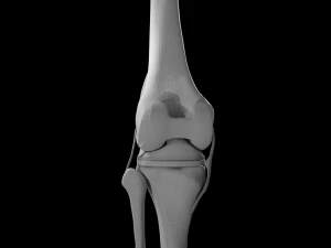 Knee Replacement 3D Model