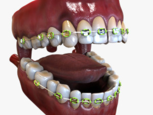 Mouth with Braces 3D Model