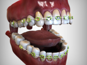 Mouth with Braces 3D Model