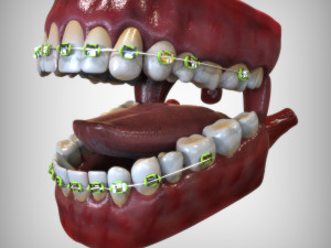 Mouth with Braces 3D Model