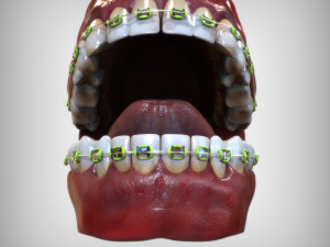 Mouth with Braces 3D Model
