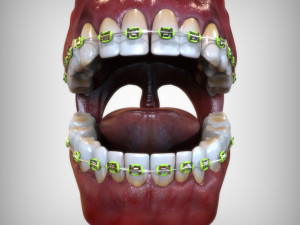 Mouth with Braces 3D Model
