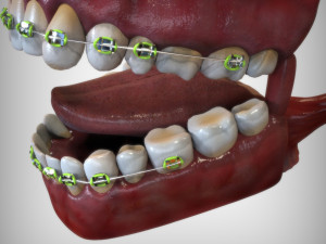 Mouth with Braces 3D Model