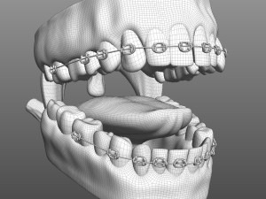 Mouth with Braces 3D Model