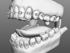 Mouth with Braces 3D Model