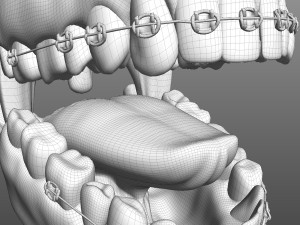 Mouth with Braces 3D Model