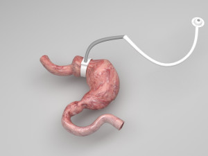 Stomach With Stomach Band 3Dモデル