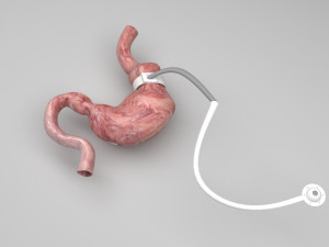 Stomach With Stomach Band 3D Model