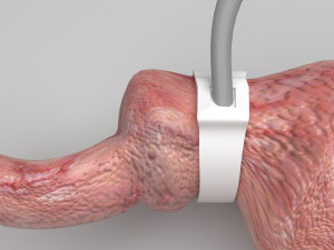 Stomach With Stomach Band 3D Model
