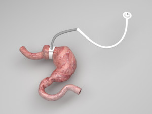 Stomach With Stomach Band 3D Model