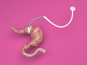 Stomach With Stomach Band 3D Model