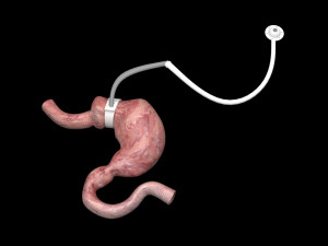 Stomach With Stomach Band 3D Model