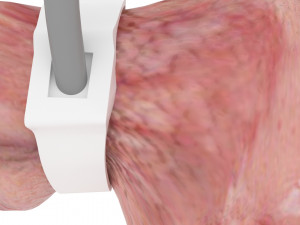 Stomach With Stomach Band 3D Model