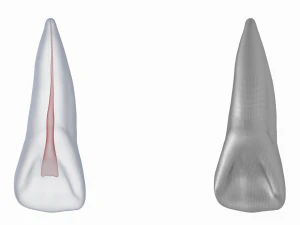 Dente incisivo centrale superiore sinistro umano con cavit&agrave; pulpare Modello 3D