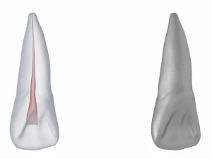 Dente incisivo centrale superiore sinistro umano con cavit&agrave; pulpare Modello 3D