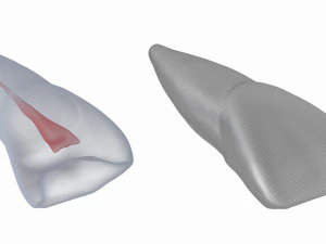 Dente incisivo centrale superiore sinistro umano con cavit&agrave; pulpare Modello 3D