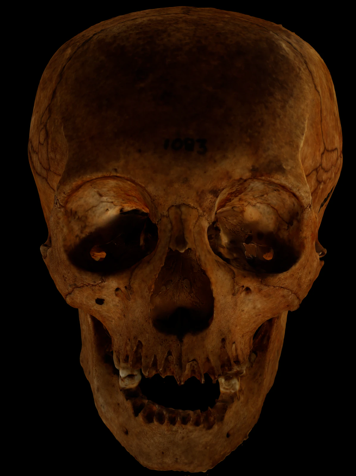 Human Skull with deformation 3D Model .c4d .max .obj .3ds .fbx .stl .blend 