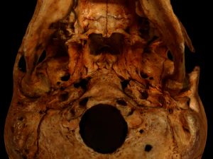 Human Skull with deformation 3D Model