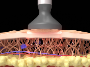 Medical motion graphic Skin Anti-Aging Treatment 3D 模型