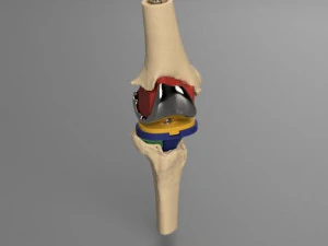 Проект полной замены коленного сустава 3D Модель