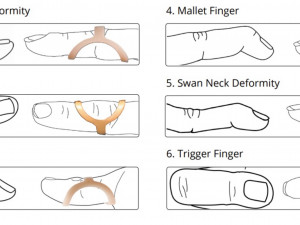 Ring splints 3D Print Model