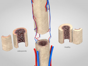 Bone with Healthy and Osteoporotic Section Modelo 3D