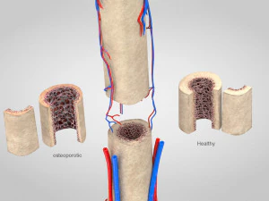 Bone with Healthy and Osteoporotic Section 3D Model