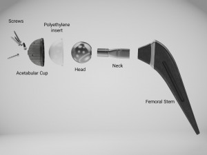 Hip Implant Low-poly 3D Model