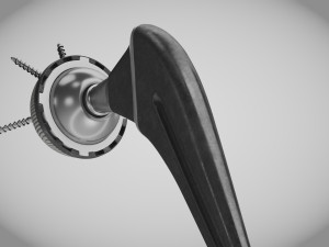 Hip Implant Low-poly 3D Model