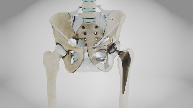 Replaced Hip Implant Modelo 3D .c4d .max .obj .3ds .fbx .stl .blend 