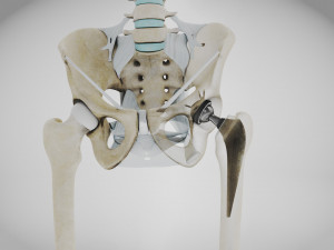 Replaced Hip Implant Modello 3D