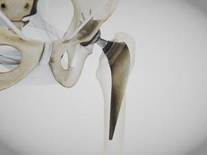 Replaced Hip Implant Modelo 3D