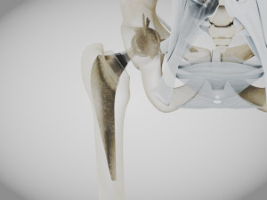 Replaced Hip Implant Modelo 3D