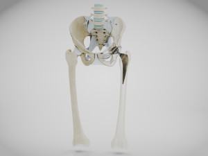 Replaced Hip Implant Modelo 3D