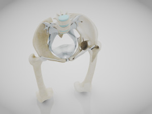 Replaced Hip Implant Modelo 3D