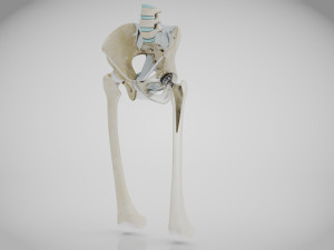 Replaced Hip Implant Modelo 3D